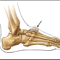 Ganglion cyst