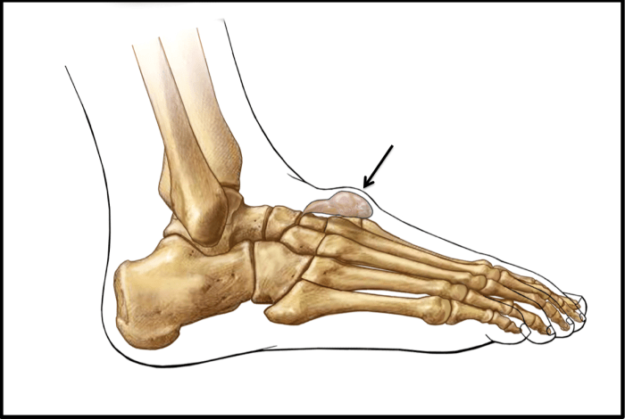 Ganglion cyst