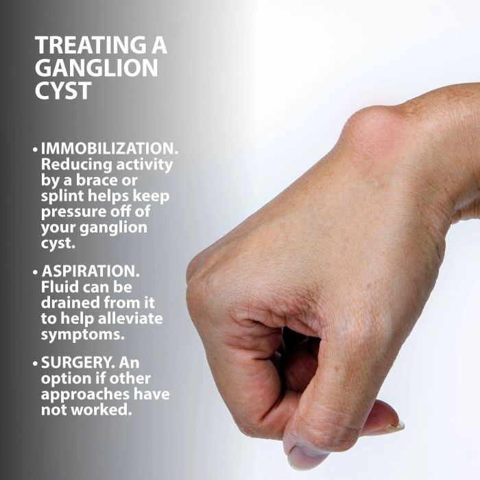 Ganglion cyst lump diagnosis