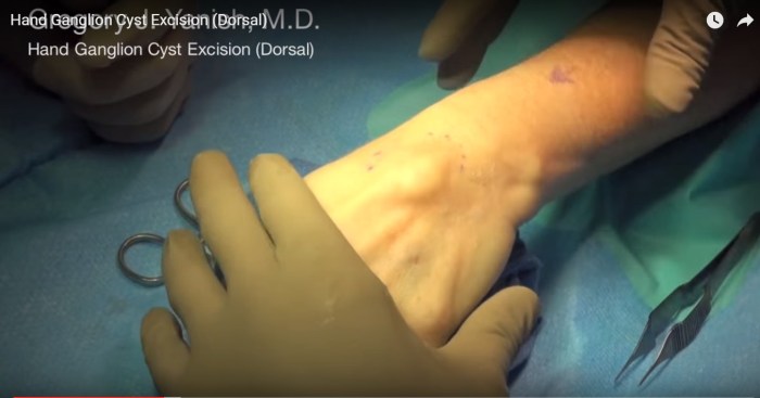 Cpt code ganglion cyst excision