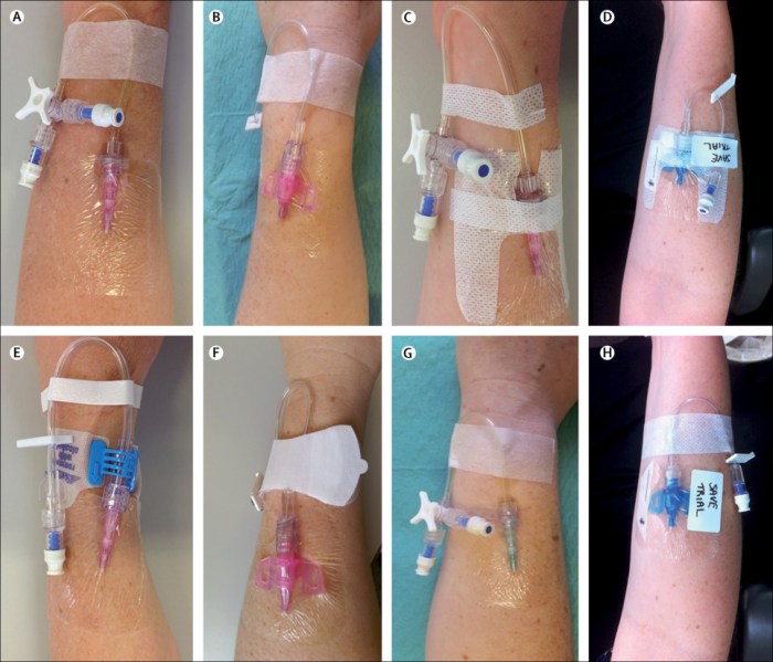 A nurse is discontinuing a peripheral iv catheter